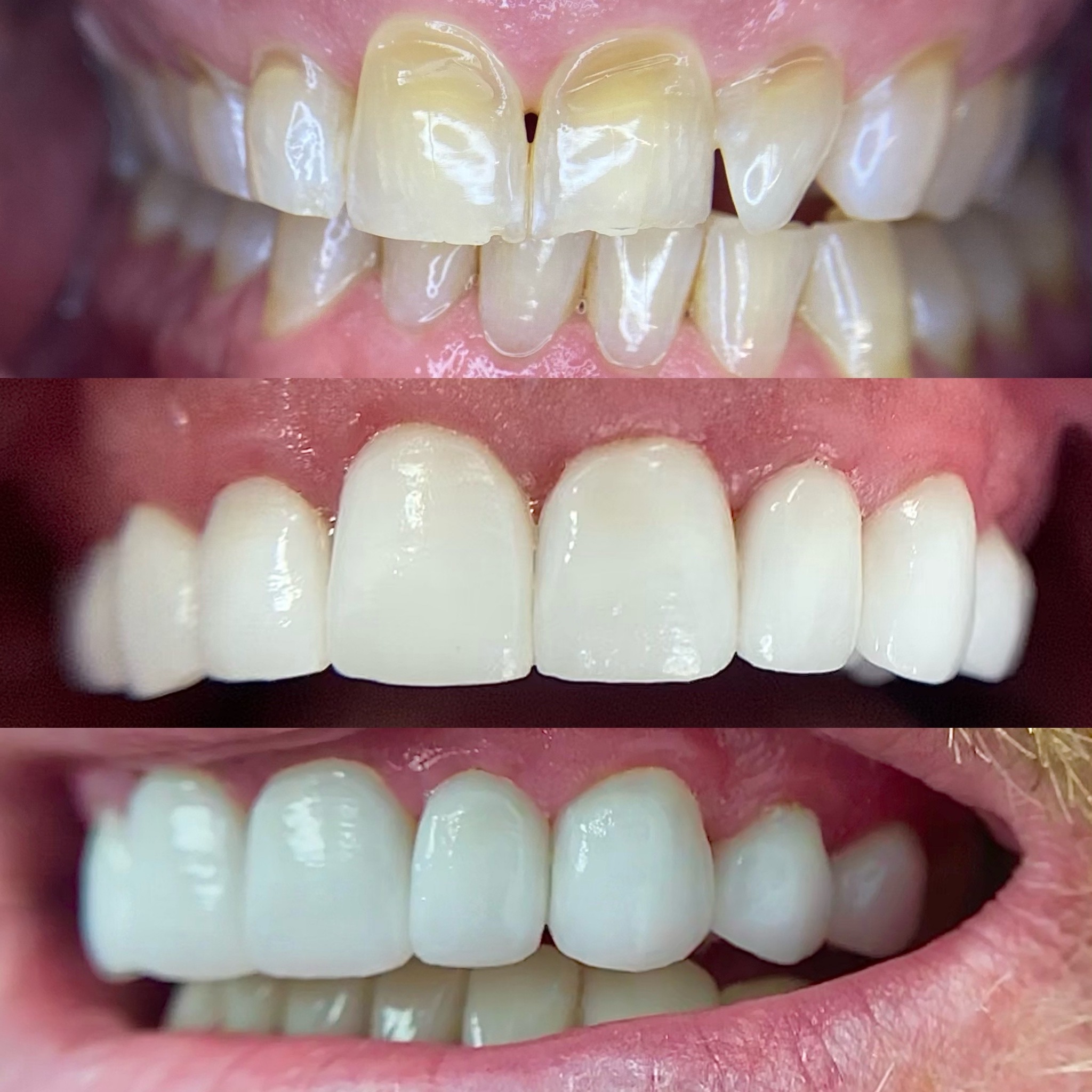 Yellowed and damaged front teeth