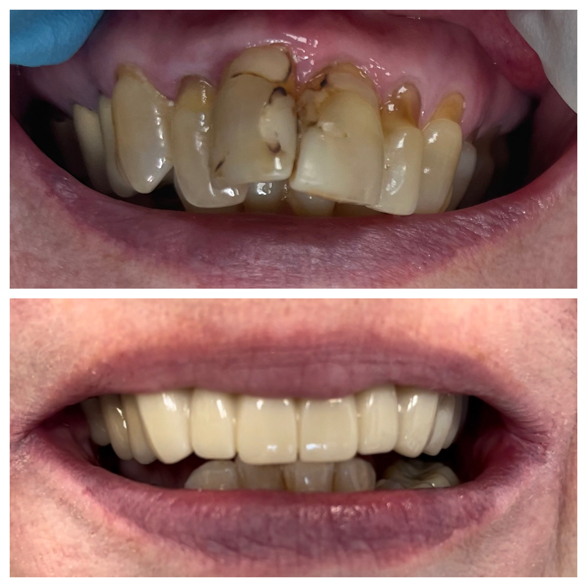 Yellowed and damaged front teeth