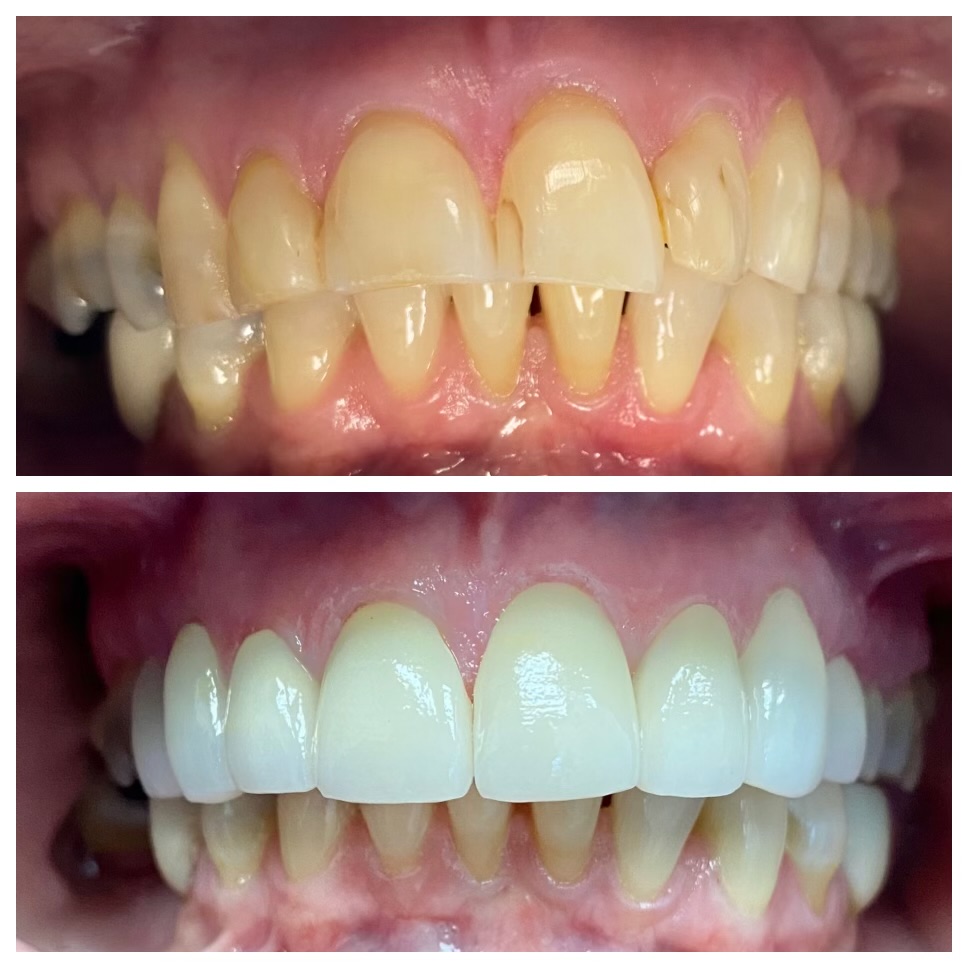 Yellowed and damaged front teeth